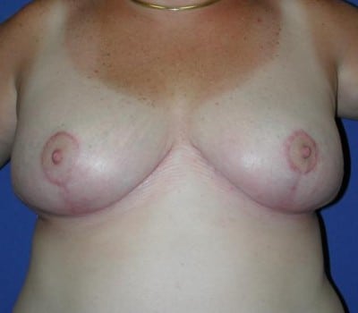 After Image: Bilateral Breast Reduction - front