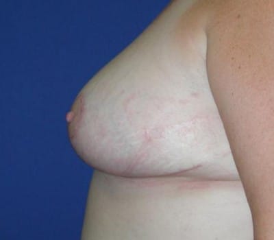 After Image: Bilateral Breast Reduction - left-side