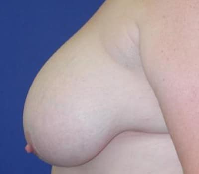 Before Image: Bilateral Breast Reduction - left-side