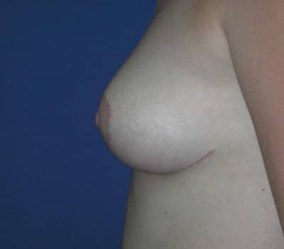 After Image: 6 Weeks Post-Op - left-side