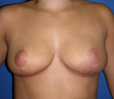 After Image: 6 Weeks Post-Op - front
