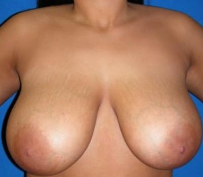 Before Image: 6 Weeks Post-Op - front