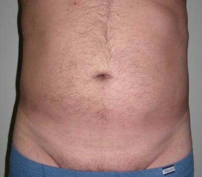 After Image: Power-Assisted Lipo - front