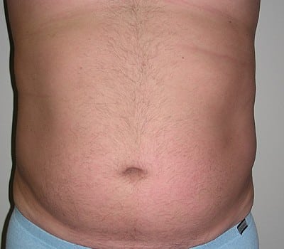 Before Image: Power-Assisted Lipo - front
