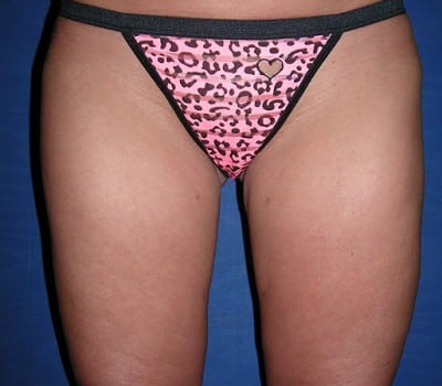 After Image: Inner & Outer Thighs Lipo - front