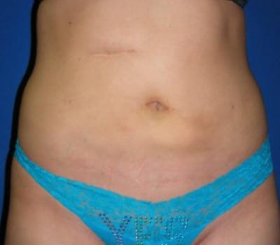 After Image: 6 Weeks Post-Op S/P Lipo - front