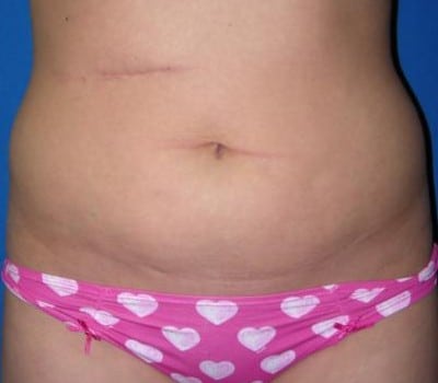 Before Image: 6 Weeks Post-Op S/P Lipo - front