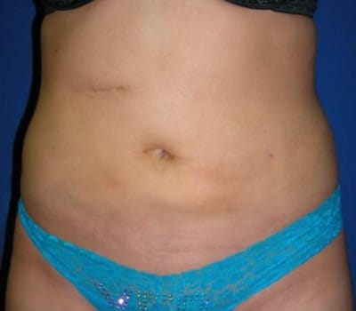After Image: 6 Weeks Post-Op S/P Lipo - other