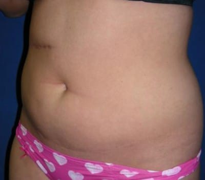 Before Image: 6 Weeks Post-Op S/P Lipo - other