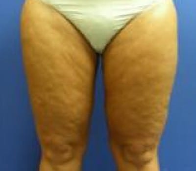 After Image: 45 Years Old Female - front