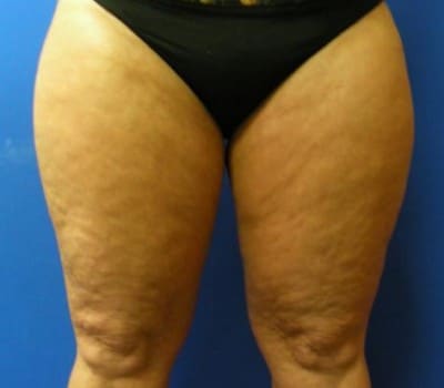 Before Image: 45 Years Old Female - front