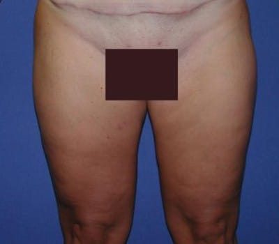 After Image: 4 Months Post-Op Thigh Lipo - front