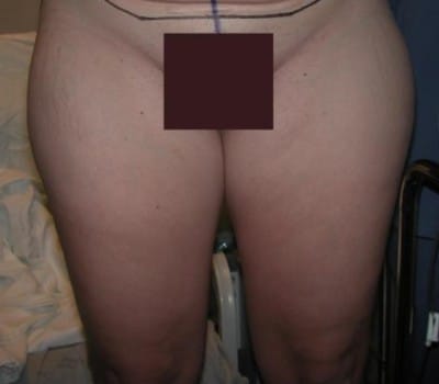 Before Image: 4 Months Post-Op Thigh Lipo - front