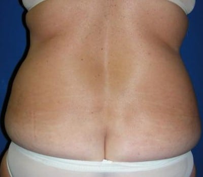 Before Image: 51 Years Old Female - back