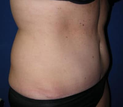 After Image: 51 Years Old Female - other
