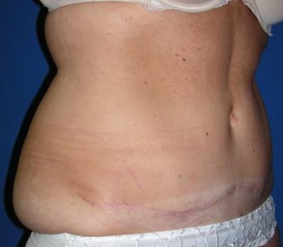Before Image: 51 Years Old Female - other