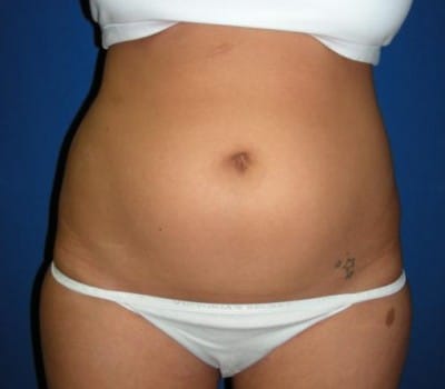 After Image: 6 Weeks Post-Op S/P Lipo - front