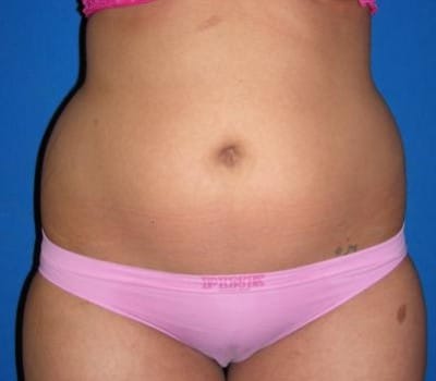 Before Image: 6 Weeks Post-Op S/P Lipo - front