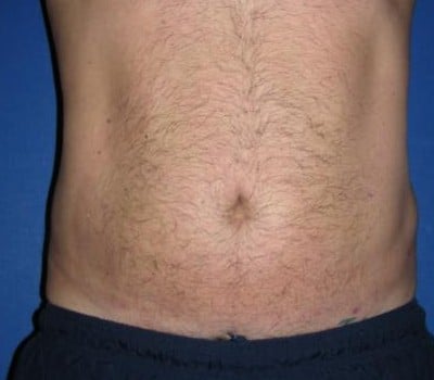 After Image: 42 Years Old Male - front