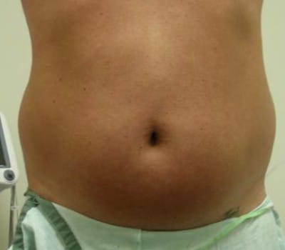 Before Image: 42 Years Old Male - front