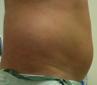Before Image: 42 Years Old Male - other