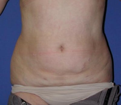 After Image: 3 Post-Op Abdominal Lipo - front