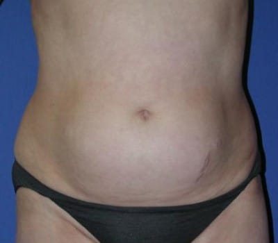 Before Image: 3 Post-Op Abdominal Lipo - front