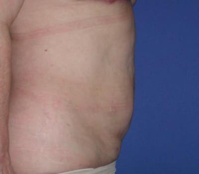 After Image: 3 Post-Op Abdominal Lipo - right-side