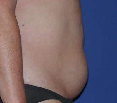 Before Image: 3 Post-Op Abdominal Lipo - right-side