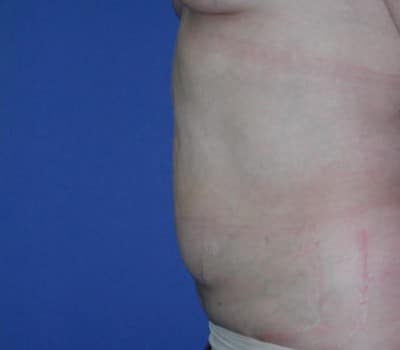 After Image: 3 Post-Op Abdominal Lipo - left-side