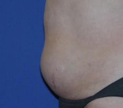 Before Image: 3 Post-Op Abdominal Lipo - left-side