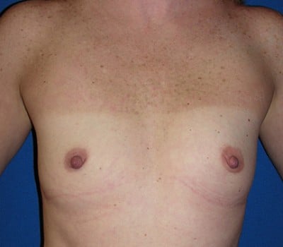 Before Image: 400cc & 350cc Silicone Gel Implants - front