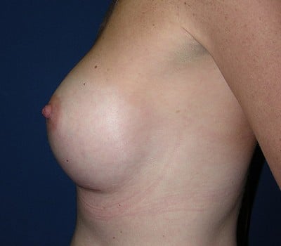 After Image: 400cc & 350cc Silicone Gel Implants - other