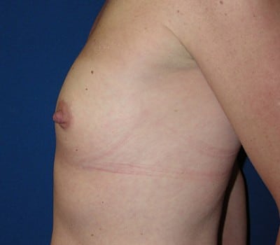 Before Image: 400cc & 350cc Silicone Gel Implants - other