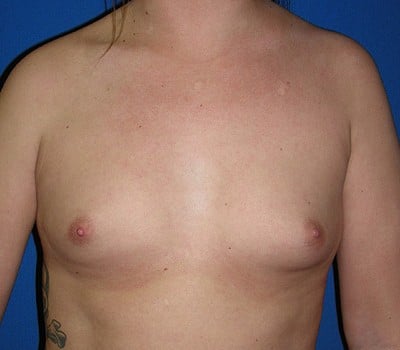 Before Image: 375cc Silicone Gel Implants - front