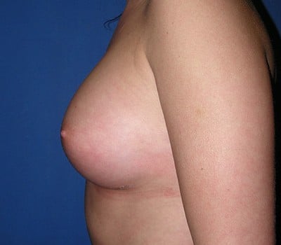 After Image: 375cc Silicone Gel Implants - other