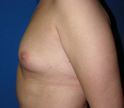Before Image: 375cc Silicone Gel Implants - other