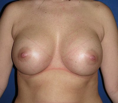 After Image: 350cc Saline Implants - front