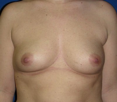 Before Image: 350cc Saline Implants - front