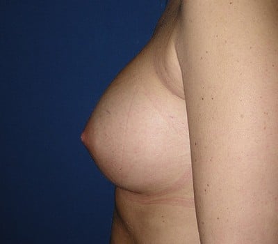 After Image: 350cc Saline Implants - other