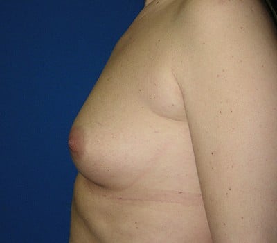 Before Image: 350cc Saline Implants - other