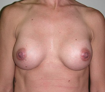 After Image: 310cc Saline Implants - front