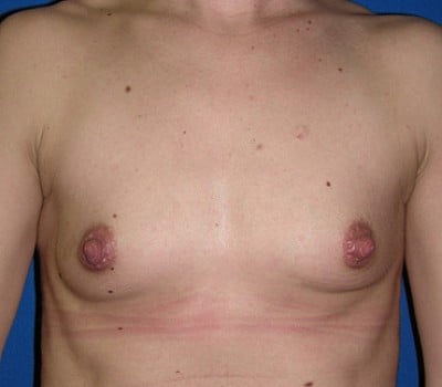 Before Image: 310cc Saline Implants - front