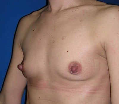 Before Image: 310cc Saline Implants - other