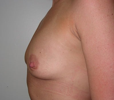 Before Image: 315cc Saline Implants - other