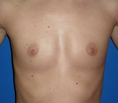 Before Image: 350cc & 400cc Silicone Gel Implants - front