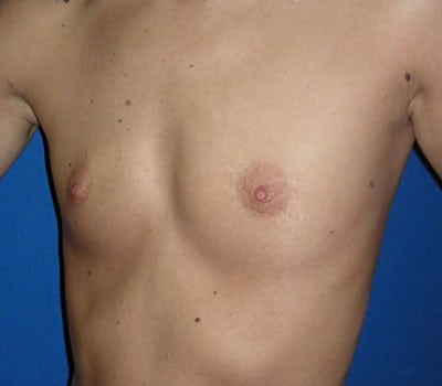 Before Image: 350cc & 400cc Silicone Gel Implants - other