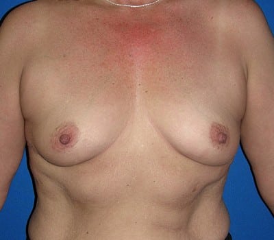 Before Image: 425cc Saline Implants - front