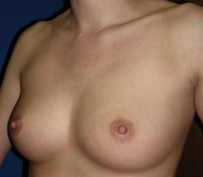 Before Image: 300cc & 325cc Silicone Gel Implants - other