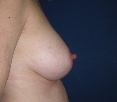 After Image: 325cc Silicone Gel Implants - other